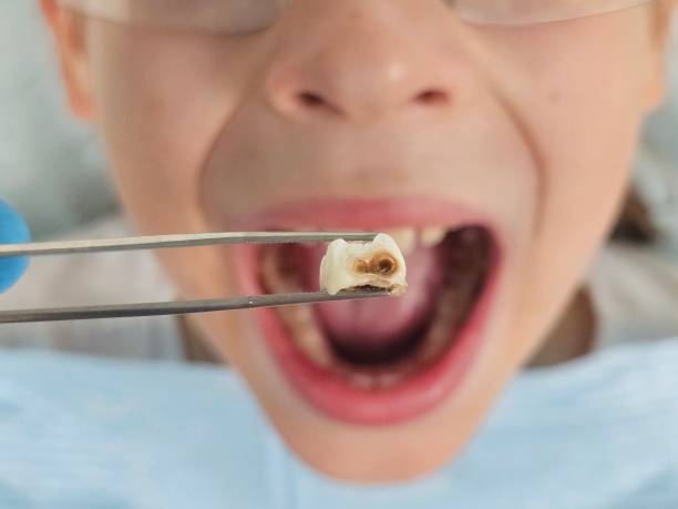 Best Emergency Treatment for Toothache in Peru, IL